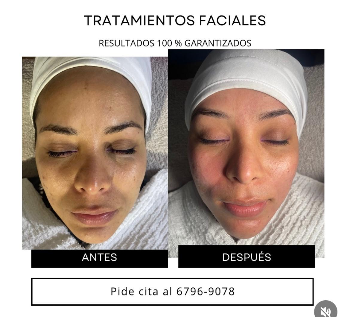 Tratamientos Faciales